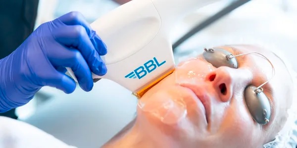 Patient receiving BBL Hero treatment for skin rejuvenation