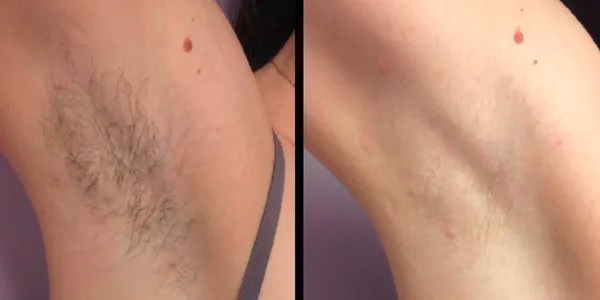 Laser hair removal session for smooth, hair-free skin