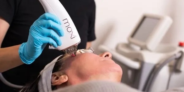 MOXI laser treatment in progress for skin resurfacing and renewal