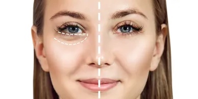 Mesotherapy session targeting under-eye dark circles and puffiness