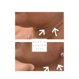 BioRevitalization-Meso-before-after3