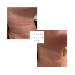 BioRevitalization-Meso-before-after4
