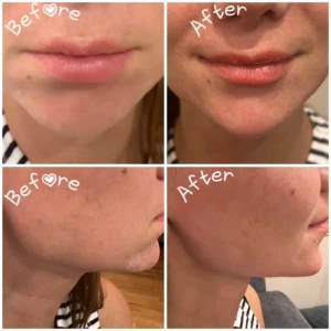 Fillers - injectables_gallery2