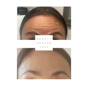 botox gallery