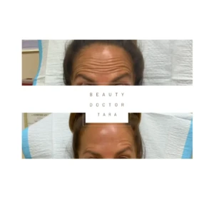 botox before after result gallery2