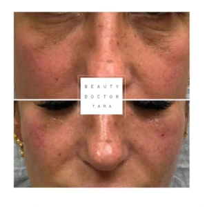 facelift liquid before after result2