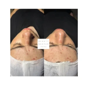 facial before after result 1