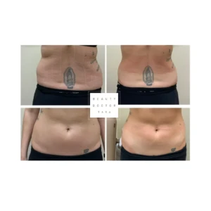 fat dissolving before after result2