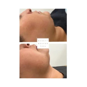 fat dissolving before after result1