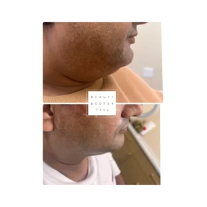 fat dissolving before after result3