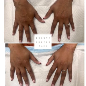 radiesse hand gallery6