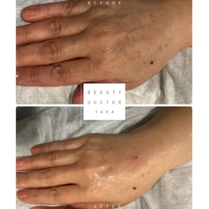 radiesse hand gallery7