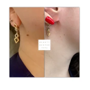 skin tag removal before after result